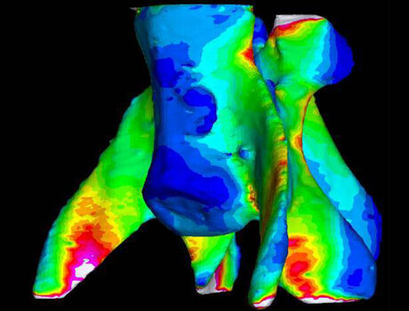 FEA model of Bone Breaking